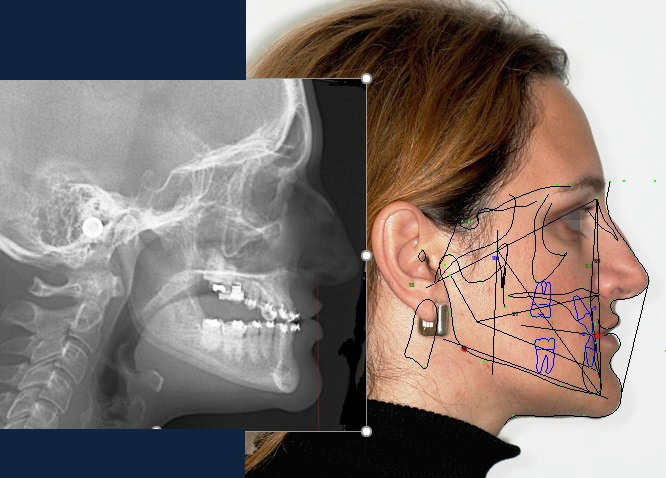 Cephalometric analysis