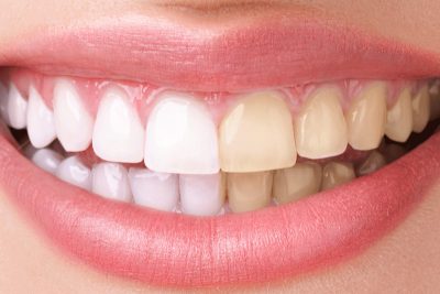 Dental Whitening