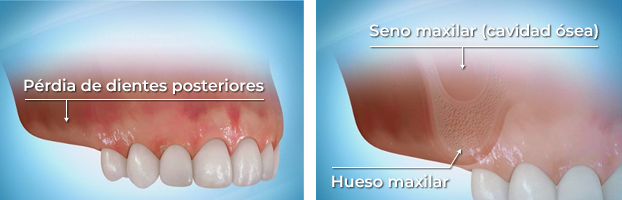 Colocación de implantes cuando hay pérdida de dientes posteriores en lo maxilar superior