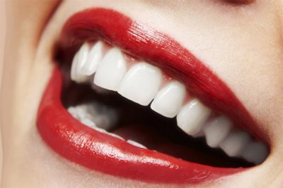 Dental Veneers