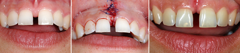 Upper lip frenectomy