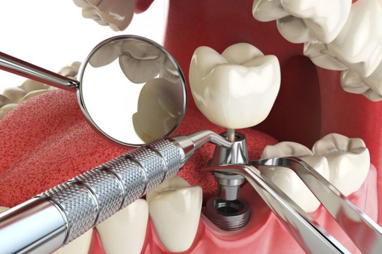 Endodontia - Ortopóvoa