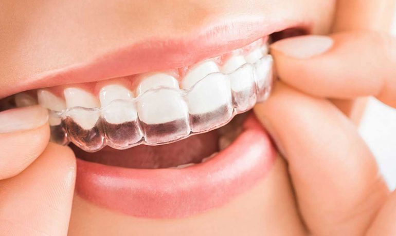 Invisalign - Ortopóvoa