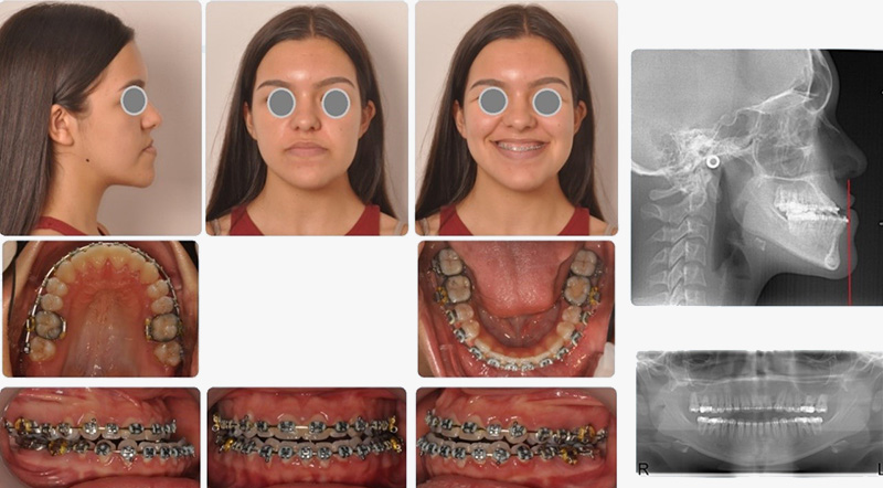 O crescimento craniofacial foi desarmonioso com um excessivo crescimento da mandíbula