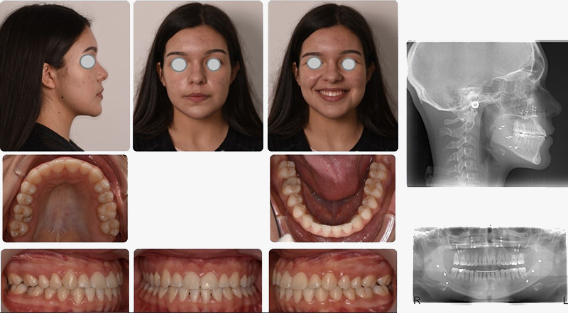 O caso terminado com uma boa estética facial e uma excelente oclusão dentária