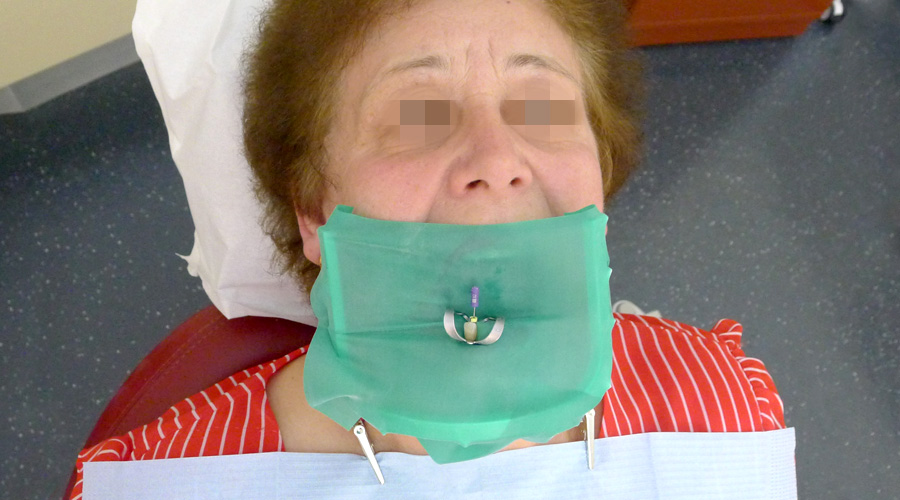 Paciente preparada para tratamento endodôntico num dente incisivo mandibular