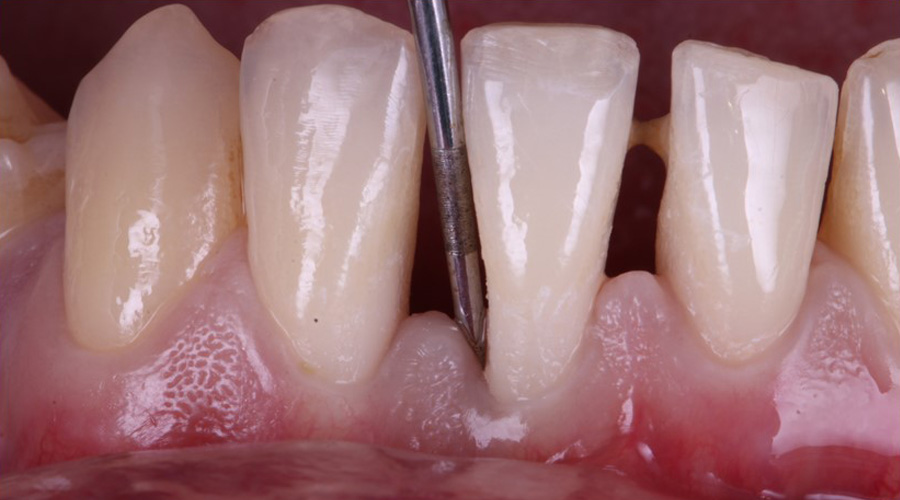 Perda de aderência clínica periodontal