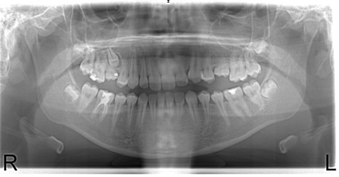 Panoramic x-ray