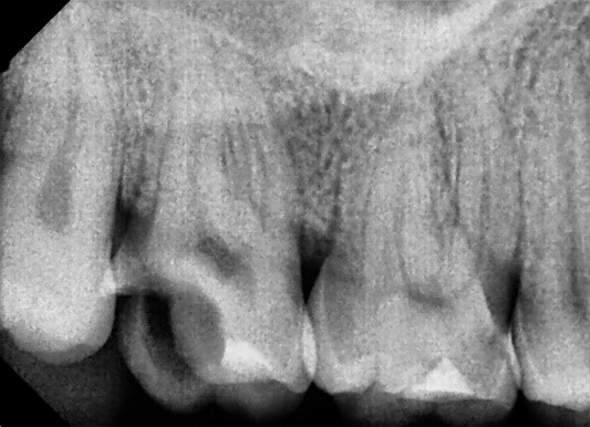 Radiografia retro-alveolar