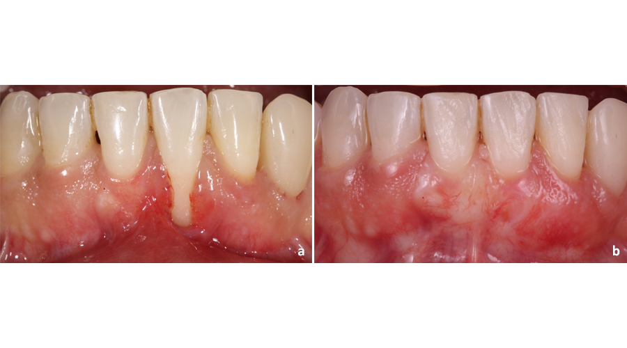 Situação clínica pré (a) e pós (b) recobrimento radicular para tratamento de recessão gengival unitária