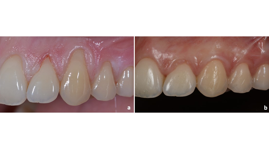 Situação clínica pré (a) e pós (b) recobrimento radicular para tratamento de recessões gengivais múltiplas adjacentes