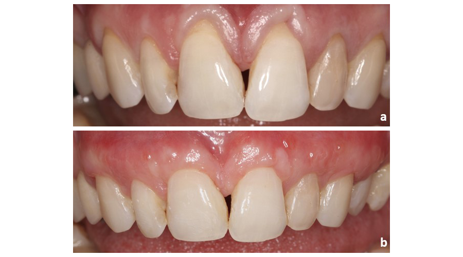 Situação clínica pré (a) e pós (b) recobrimento radicular para tratamento de recessões gengivais múltiplas adjacentes