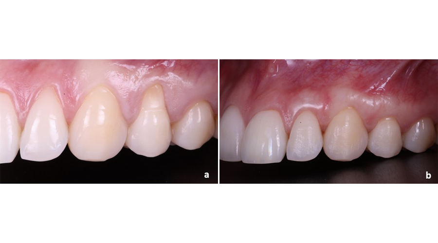 Situação clínica pré (a) e pós (b) recobrimento radicular para tratamento de recessões gengivais múltiplas adjacentes