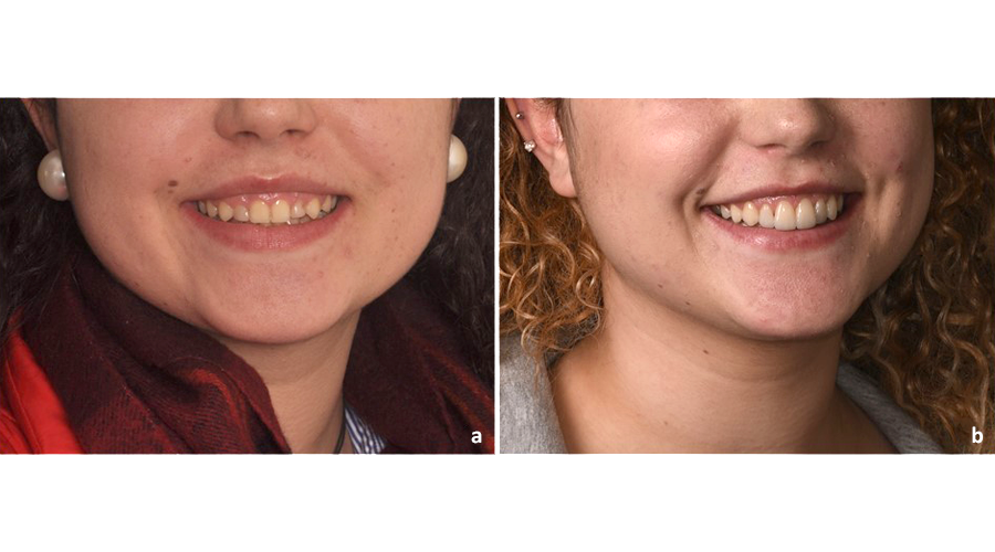 Situação extra-oral pré (a) e pós (b) alongamento da coroa clínica para tratamento do sorriso gengival