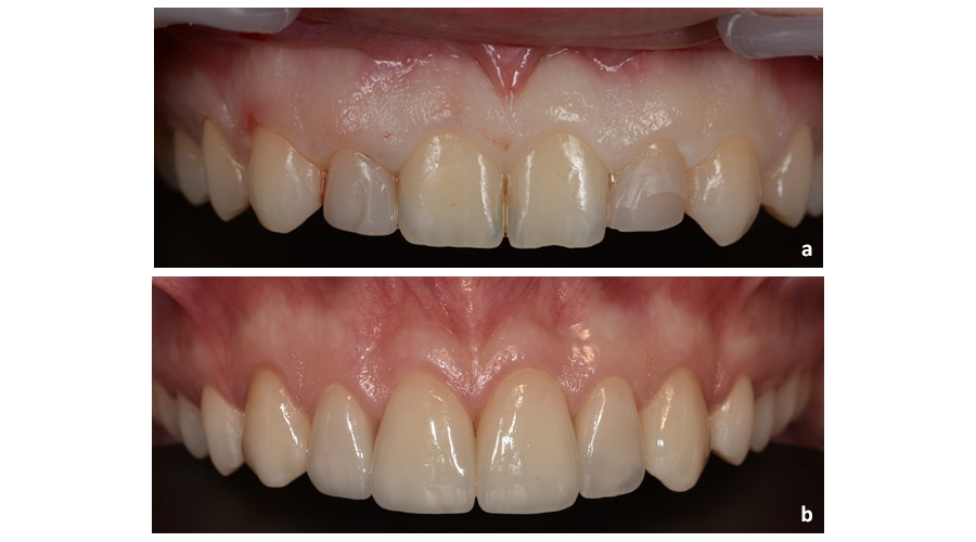 Situação intra-oral pré (a) e pós (b) alongamento da coroa clínica para tratamento do sorriso gengival