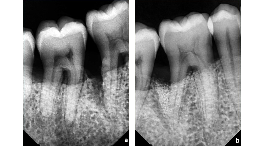 Situação radiográfica pré (a) e pós (b) cirurgia periodontal regenerativa para recuperação de suporte ósseo perdido