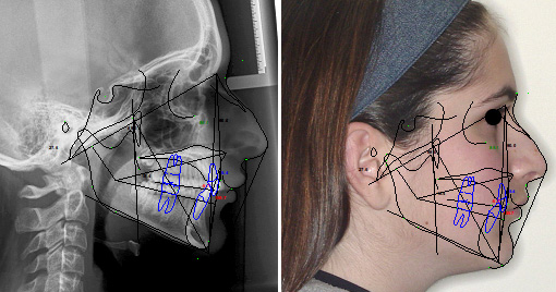 Lateral cephalogram of the face