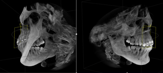 Computerized Axial Tomography (CAT)