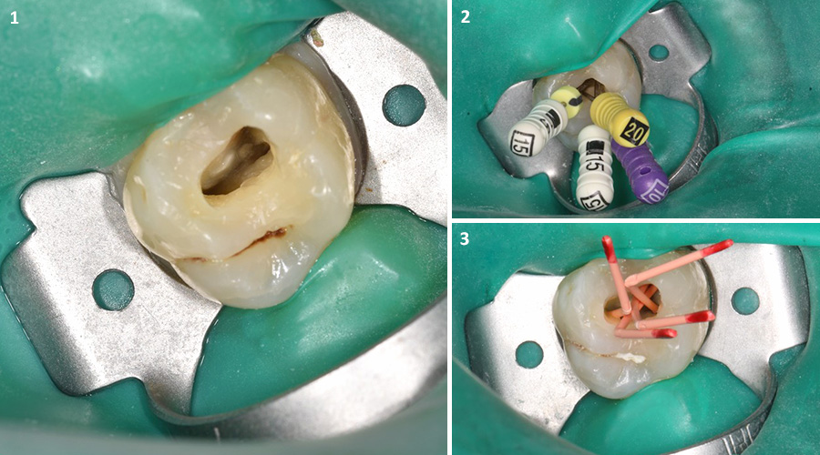 Tratamento endodôntico de um dente molar. (1) Dente isolado do meio bucal com o dique de borracha, exibindo a câmara pulpar que permitirá o acesso aos canais pulpares; (2) Limas endodônticas colocadas nos canais pulpares; (3) Cones de guta-percha para obturar os canais pulpares.