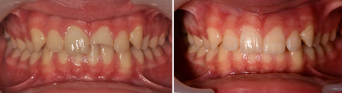 Tratamentos de dentisteria operatória