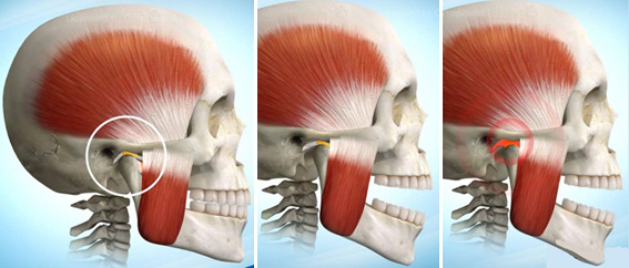 Tratamentos da disfunção articular temporomandibular e dor orofacial